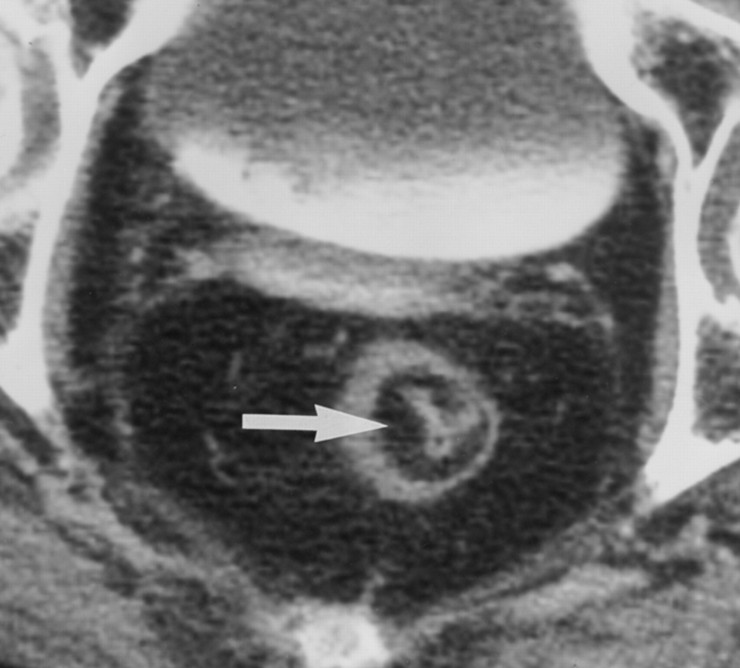 Bowel Wall Thickening 