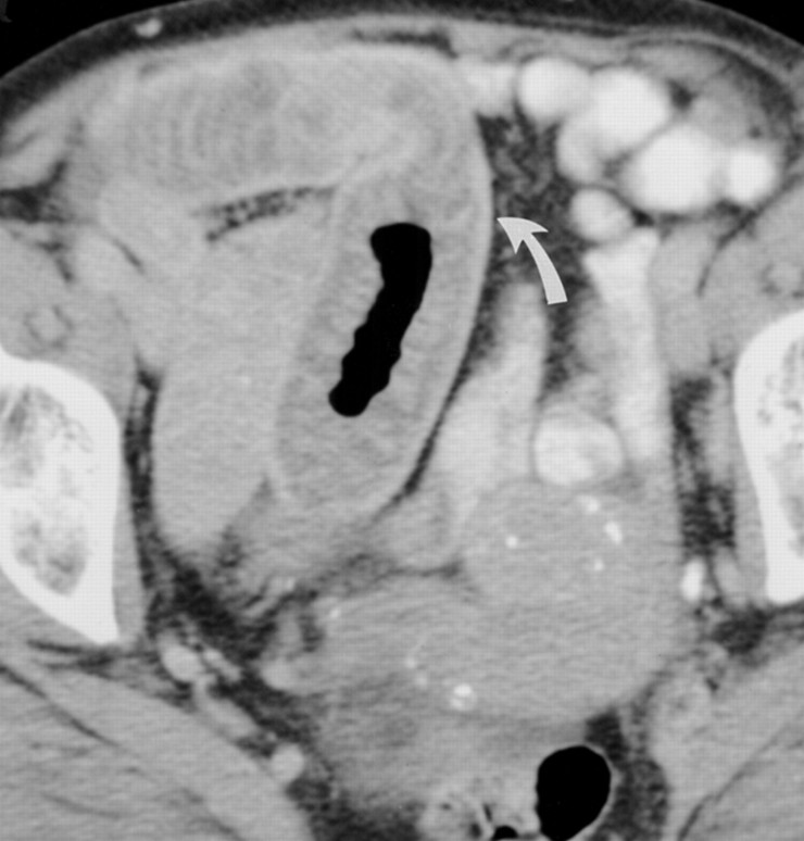 Bowel Wall Thickening 