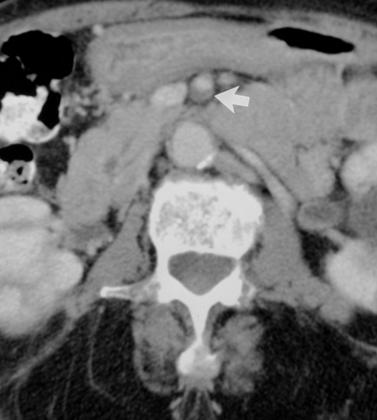 Bowel Wall Thickening 
