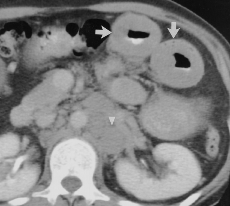 Bowel Wall Thickening 