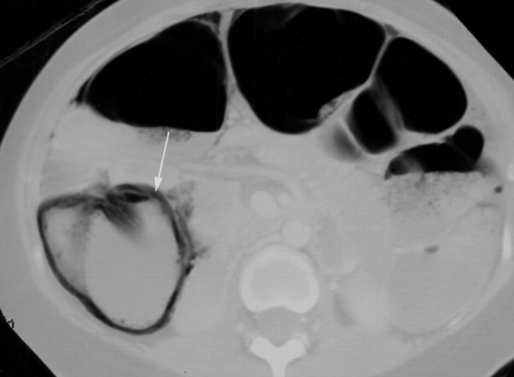 Bowel Wall Thickening 