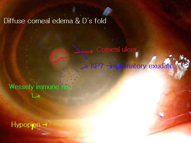 각막 궤양과 Wessely Ring 네이버 블로그