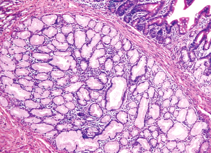 브루너샘 과형성증(Brunner's gland hyperplasia) 네이버 블로그
