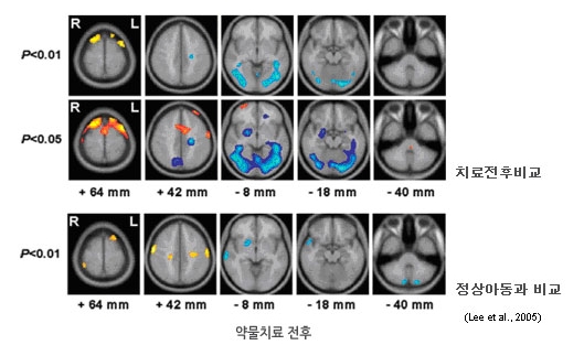 modafinil