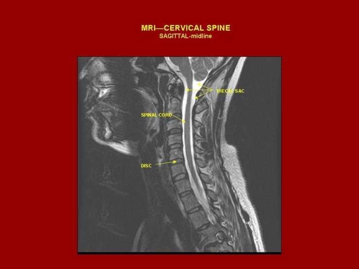 normal spine x-ray,mri,ct - 블로그