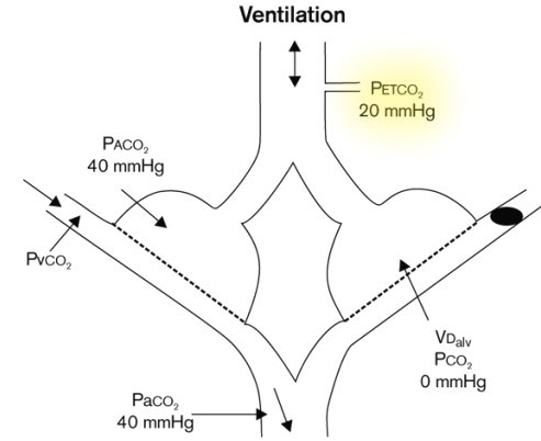dead space ventilation equation paco2 etco2