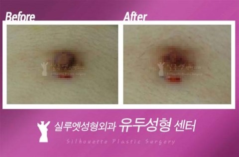 남자유두축소수술 왜 하는지 궁금해? 궁금하면 클릭해!!! : 네이버 블로그 남자유두축소수술 왜 하는지 궁금해? 궁금하면 클릭해!!! : 네이버 블로그