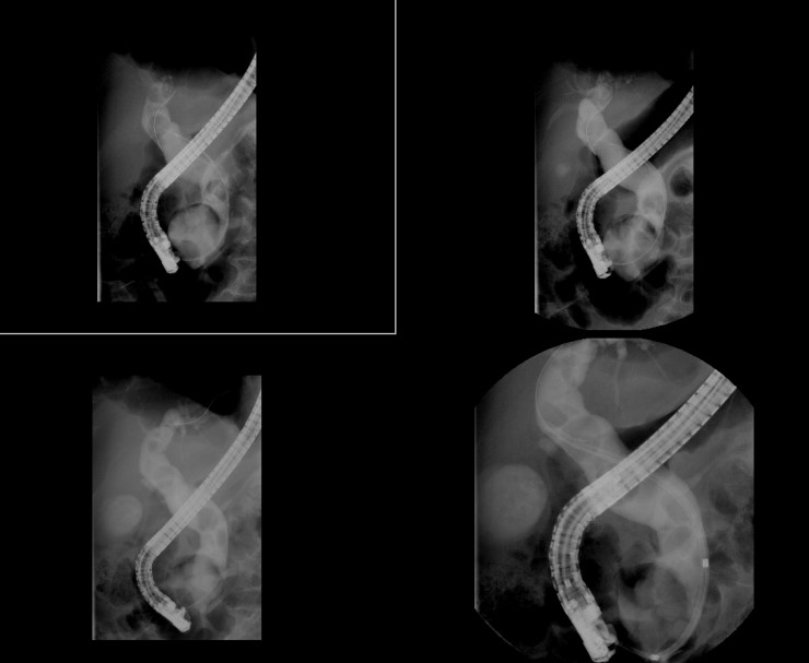 ERBD (Endoscopic Retrograde Biliary Drainage) 네이버 블로그