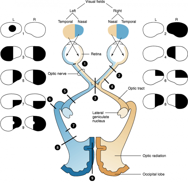 Hemianopsia vs Hemianopia 네이버 블로그