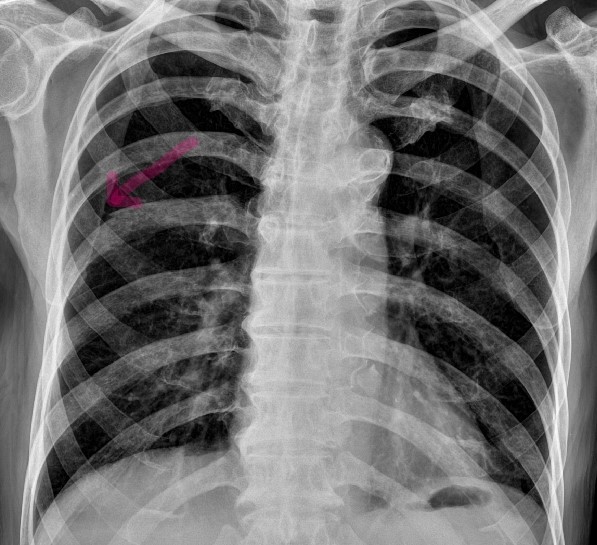 Rib fracture 네이버 블로그