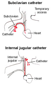 Permacath Vs Vas Cath Shefalitayal