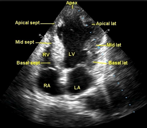 regional-wall-motion-abnormality