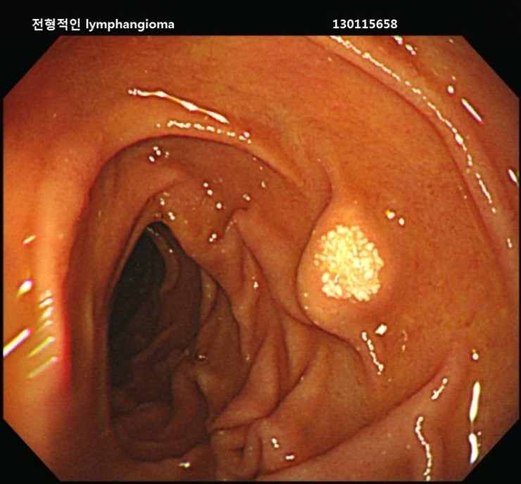 lymphangioma, duodenum : 네이버 블로그