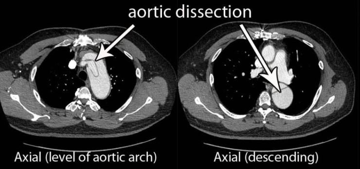 aortic dissection : 네이버 블로그