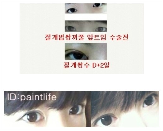 쌍꺼풀 자연스러운 인라인 인아웃라인 후기† : 네이버 블로그 쌍꺼풀 자연스러운 인라인 인아웃라인 후기† : 네이버 블로그