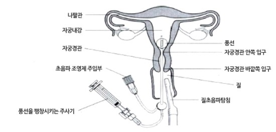 산부인과진료 자궁난관조영 초음파hycosy 조영술hsg 네이버 블로그