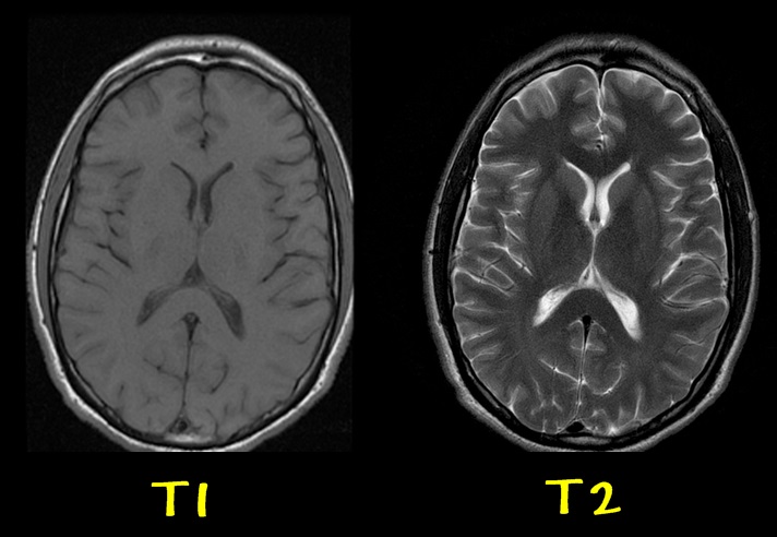 mri-t1-t2