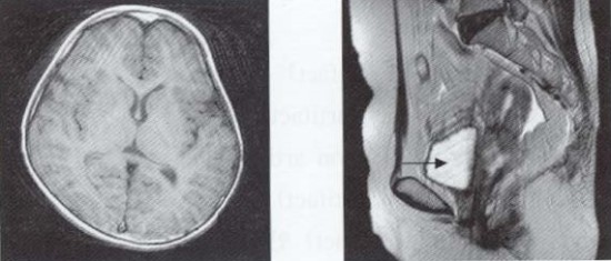 What Causes Ghosting Artifact Mri