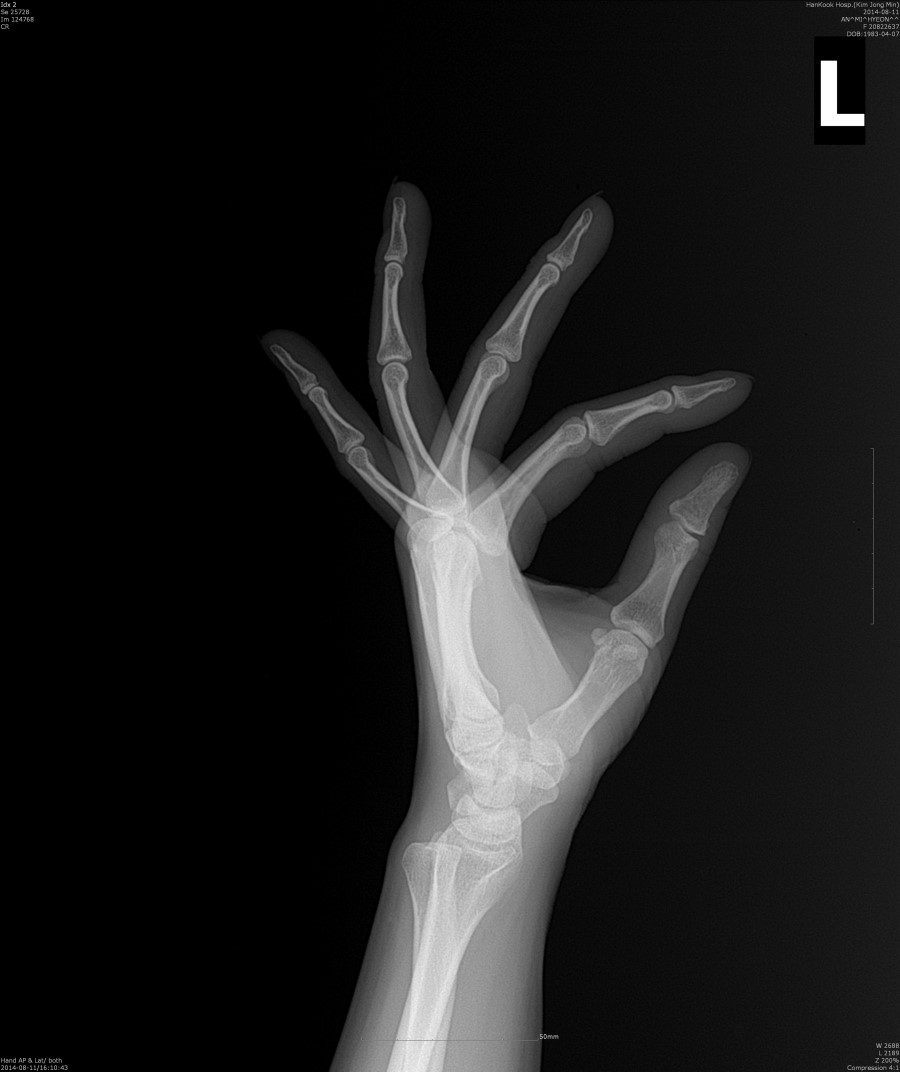 Upper extermity 방사선검사메뉴얼 네이버 블로그