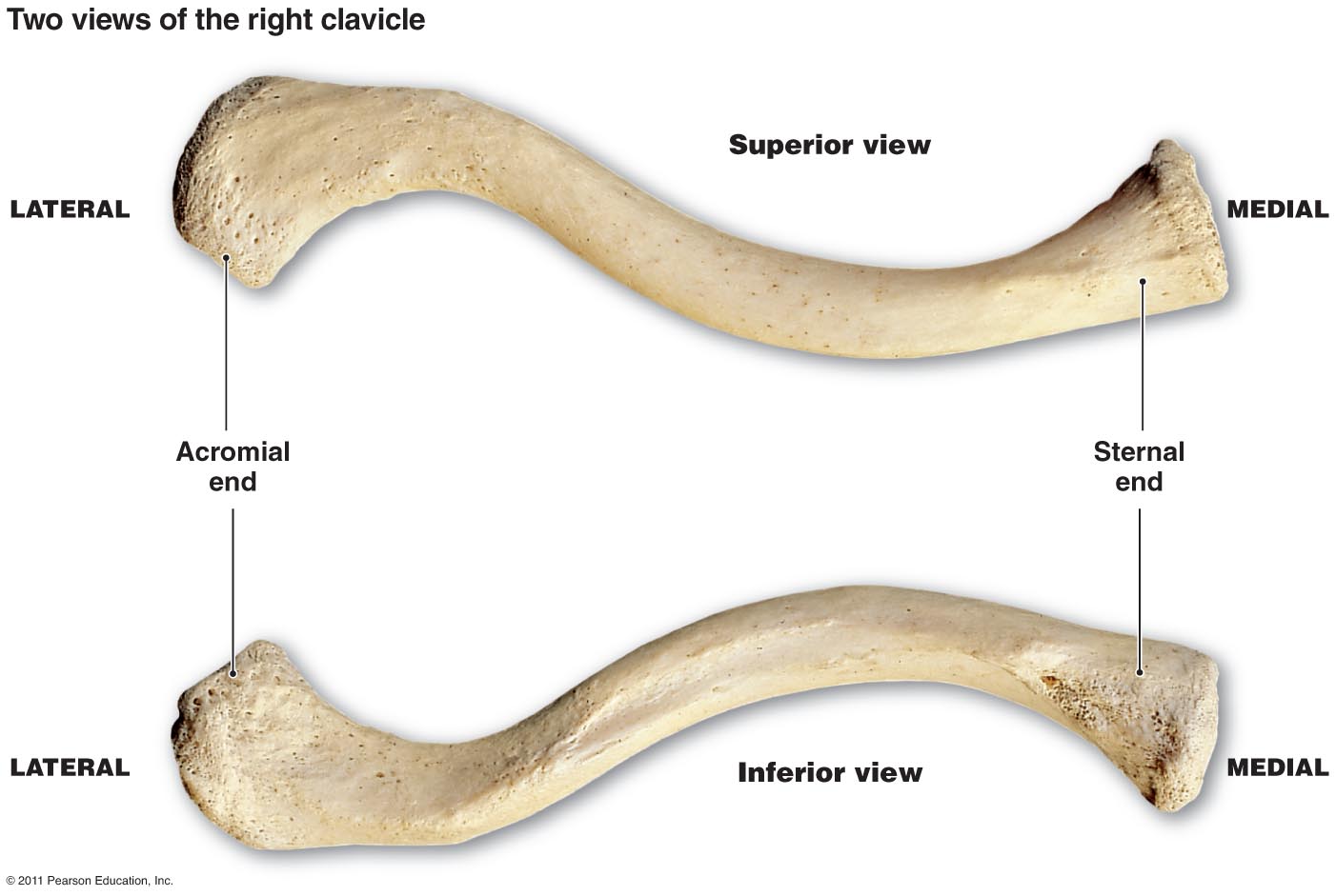 pathological disease of clavicle
