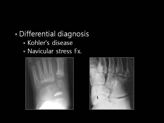 Accessory Bones Of Foot Accessory Navicular