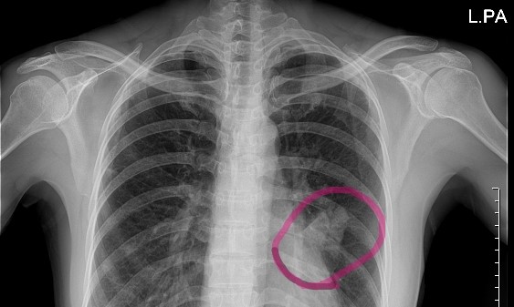 pneumonia-pleuritic-chest-pain