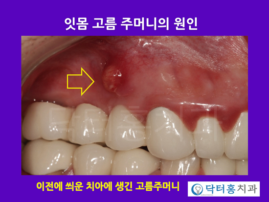잇몸 고름주머니, 원인과 치료법 : 네이버 블로그