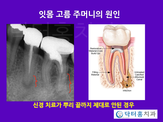 잇몸 고름주머니, 원인과 치료법 : 네이버 블로그