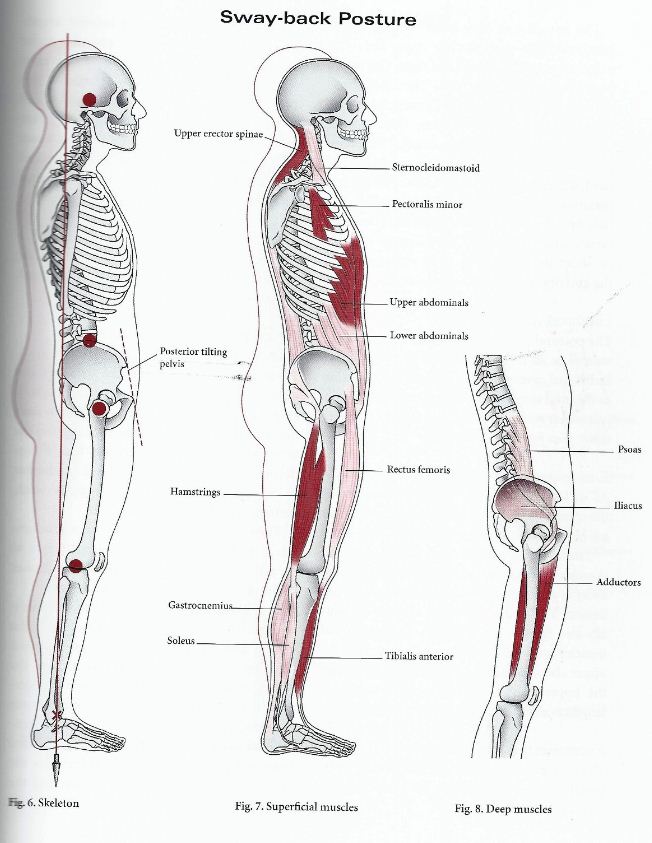굽은등(Sway Back) 네이버 블로그