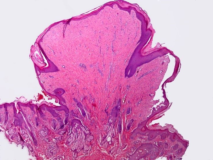 photos of hymenal skin tags