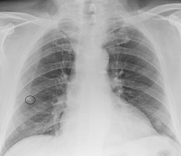 Bone island on Xray 네이버 블로그