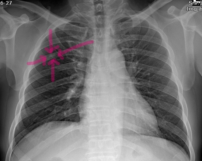 Bone island on Xray 네이버 블로그