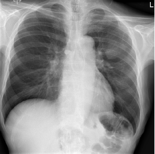 Xray 판독법 (carina, CPA angle, gastric bubble, Bowel perforation) 네이버 블로그