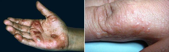 Dyshidrotic eczema 한포진과 토음체질 네이버 블로그