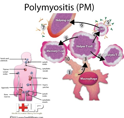 polymyositis & dermatomyositis 네이버 블로그