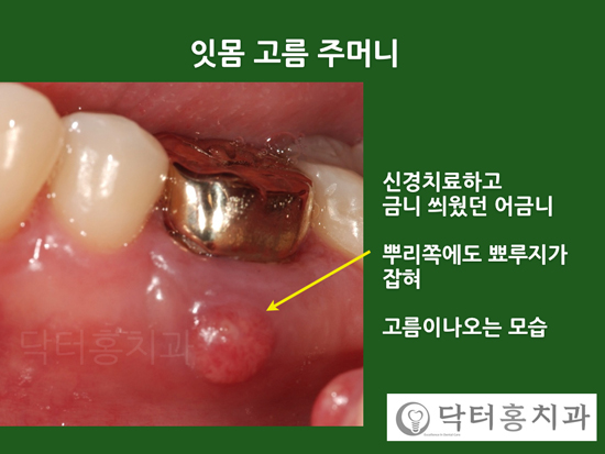 앞니 잇몸 염증 고름주머니 생긴 경우, 치료는? : 네이버 블로그