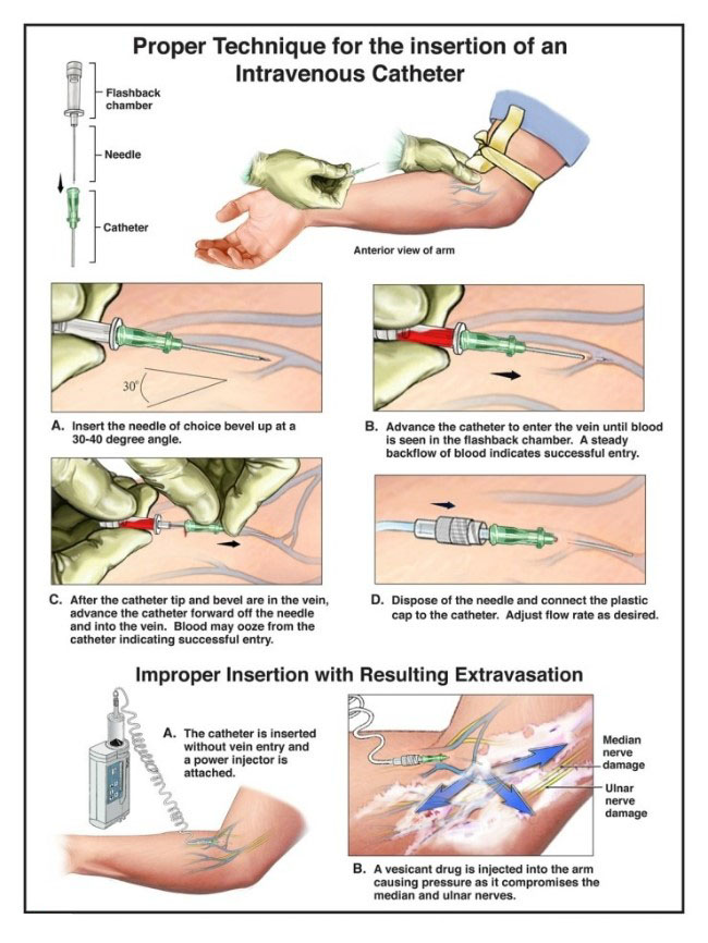 iv-cannulation