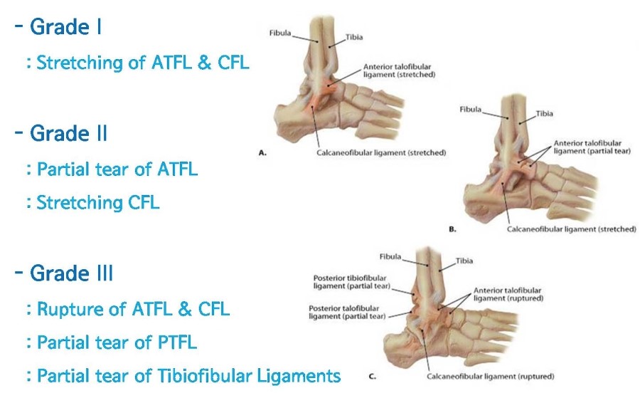 How To Rehab A Grade 3 Ankle Sprain