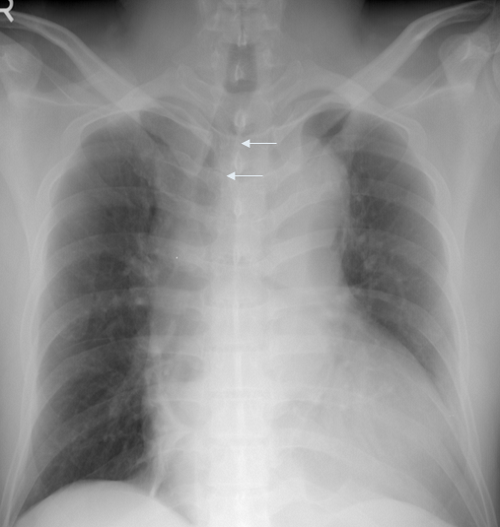 Chest Radiograph Finding Of Aortic Dissection