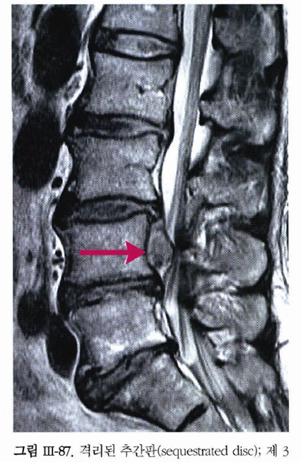 허리디스크: 요추 추간판 탈출증 (Herniated Inter-vertebral Disc) - 블로그