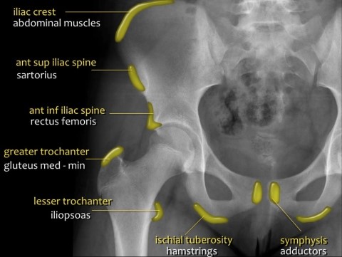 골반 견열골절(Pelvic avulsion fracture) : 갑작스럽게 고관절 주위 근육의 심한 ...