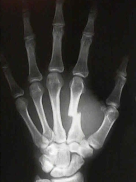 base of 1st metacarpal fracture