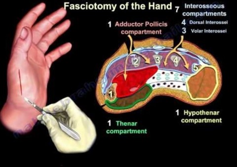 forearm compartment syndrome treatment