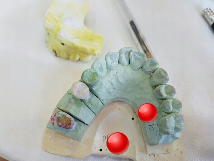 임시치아 제작 과정 만드는 법 만들기 Temporary crown Jacket crown 네이버 블로그