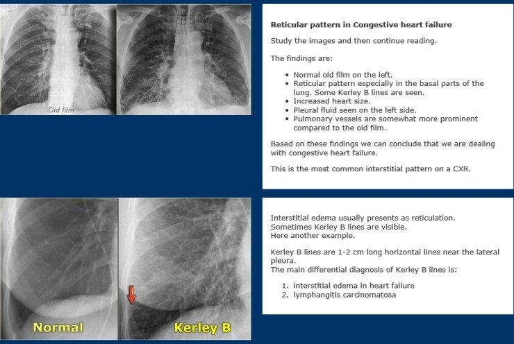 Chest X Ray 4 Pattern Approach 네이버 블로그 1477