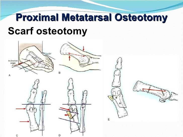 scarf-osteotomy-proximal-chevron