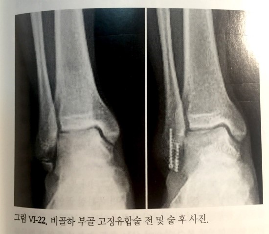 Ankle Disease Accessory Bones Of Foot