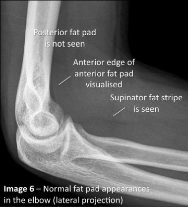 Elbow X ray Fat Pad Sign elbow-x-ray-fat-pad-sign