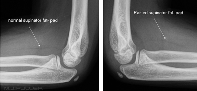 Elbow X-ray의 Fat pad sign : 네이버 블로그
