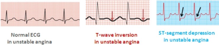 unstable-angina